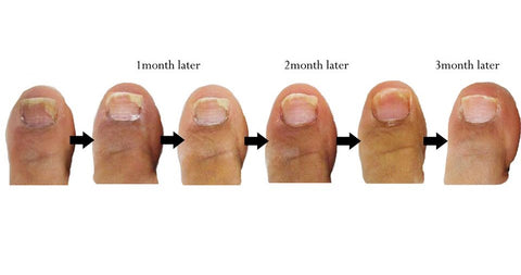 Amazon.com : Toenail Fungus Treatment Extra Strength, Nail Fungus Treatment,  Nail Fungus Treatment for Toenail & Fingernails, Fungal Nail Treatment for  Toenails, Antifungal Nail Treatment for Athletes Foot (1oz) : Health &